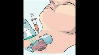 تجویز نمونه برداری از غده تیروئید