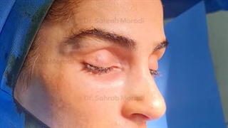 عمل زیبایی بینی