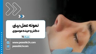 دکتر وحیده موسوی بهترین جراح بینی در مشهد رفع افتادگی پلک
