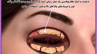 هزینه عمل بلفاروپلاستی سال ۱۴۰۲