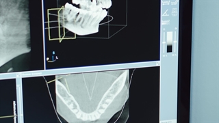 تقویت لثه تحلیل رفته + قرص تقویت لثه