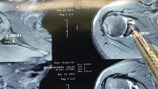فیلم جراحی تاندون شانه با لیزر