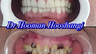 نمونه جراحی ایمپلنت دندان در تهران
