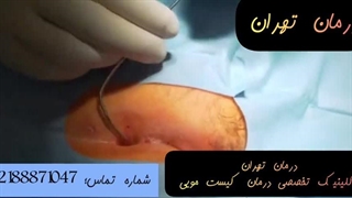 فیلم عمل کیست مویی باز - سینوس پیلونیدال