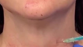 میکرو بوتاکس گردن