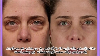 نتیجه نهایی عمل بلفاروپلاستی پلک پایین