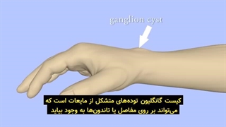 کیست گانگلیون مچ دست و عمل جراحی