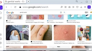 برای گرفتن واکسن HPV چه نسخه ای لازم هست؟
