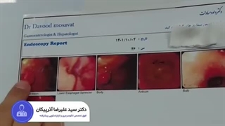 جراحی لاپاراسکوپیک تومور نورواندوکرین معده