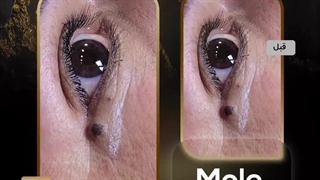 نمونه کار برداشتن خال و زگیل در ارومیه