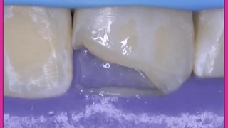 کامپوزیت دندان