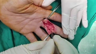 جراحی عصب دست