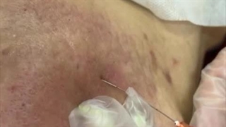 سابسیژن با پوست ما چیکار میکنه