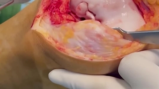 موزاییک پلاستی (پیوند غضروف)