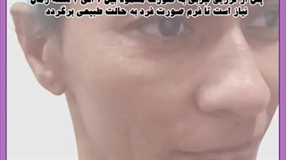 تزریق چربی به صورت تزریق چربی