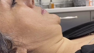 فیلم قبل و بعد لیپوساکشن غبغب