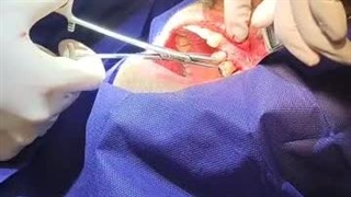 ایمپلنت کار حرفه ای -2