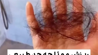 ریزش مو تا چه حدی طبیعی است؟ درمان ریزش مو با مالالیز