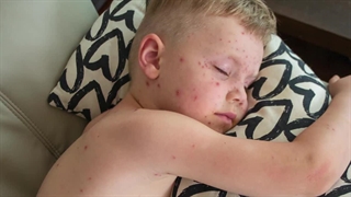 برای آبله مرغان چی بخوریم ؟