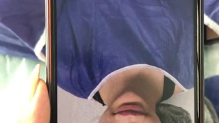 جمع کردن پره بینی و لیفت لب در کلینیک ارتین