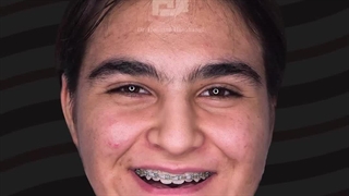 جراحی همزمان دو فک و چانه