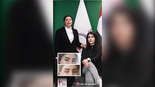 Mini Facelift: Reignite Your Youthful Radiance