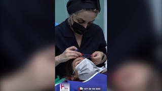 زراعة الحواجب فی هیلیا: النتائج المذهلة قبل وبعد