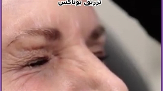 تزریق بوتاکس ترمیم سوختگی