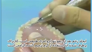 قیمت پروتز دندان