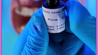 ارتودنسی لیفت پیشانی