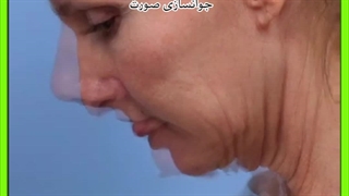 جوانسازی صورت جراحی فک