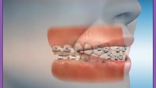 ارتودنسی لمینت