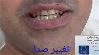 جراحی تغییر صدا توسط جراح حنجره ی معروف، دکتر زهرا سرافراز