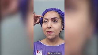 زراعة الحواجب مع ضمان مدى الحیاة