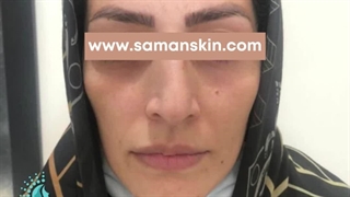تزریق چربی به گونه لیپوست