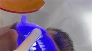 ترکیب لمینت مشهد و روکش دندان در دندانپزشکی بارانا