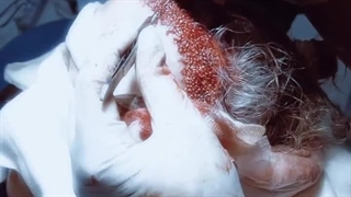 کاشت مو به روش SUT ترمیم سوختگی