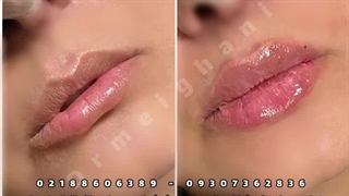 تزریق فیلر و فرم دهی لب