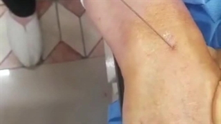 تزریق چربی دست برداشتن خال