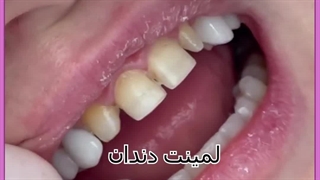 لمینت دندان اصلاح فرم صورت