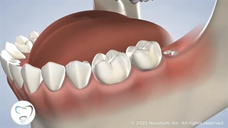 جراحی دندان عقل : کلینیک دندان پزشکی دکتر دهقان