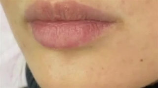 تزریق ژل لب در کرج