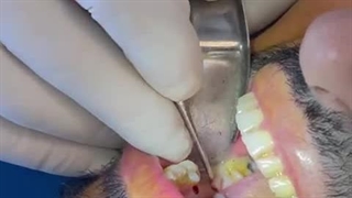 ایمپلنت پانچ چیست