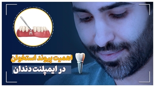 اهمیت پیوند استخوان در ایمپلنت