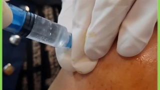 پرولوتراپی زانو دکتر لیلا بهاری فوق تخصص درد کلینیک مهرگان کلینیک لیزر