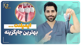 ایمپلنت بهترین جایگزینه