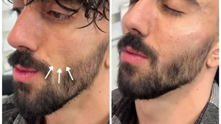 تزریق فیلر جهت پر کردن گونه و از فرم دهی به صورت و گونه