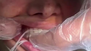 ریتنشن فک پایین