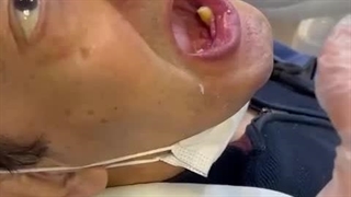 فیلم گذاشتن دندان مصنوعی