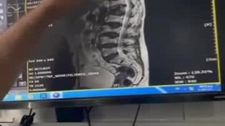 جراحی مهره شکسته ستون فقرات